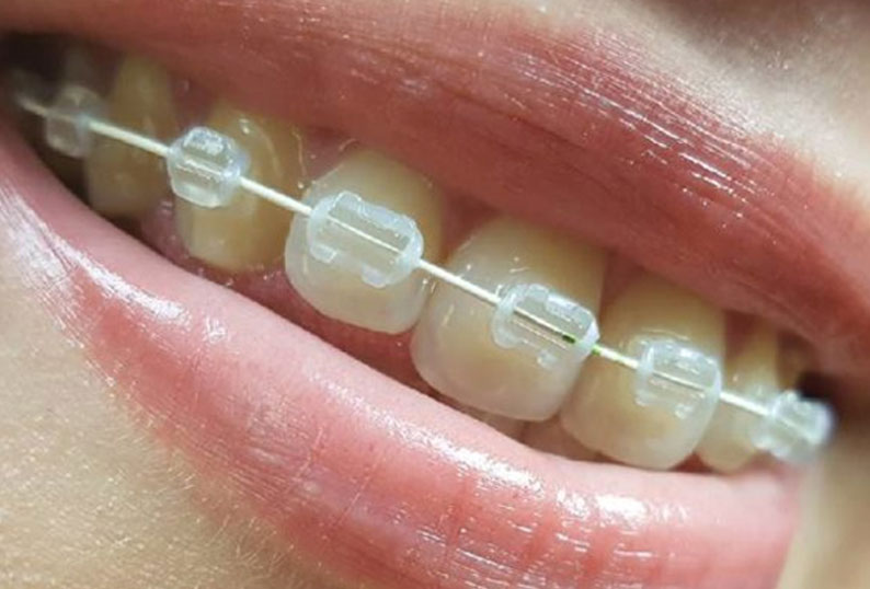 Helpful Tips For People With Braces