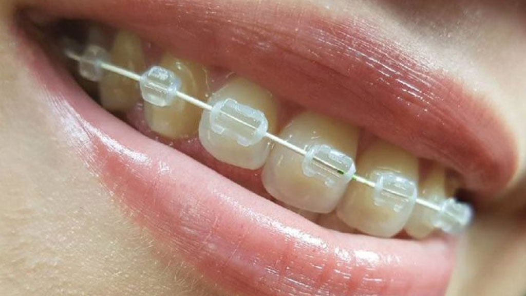Helpful Tips For People With Braces